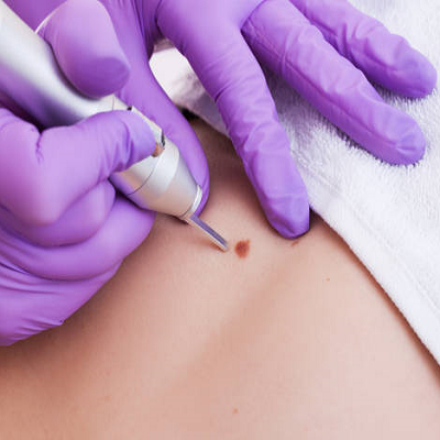 Skin Lesion Removal Cost in Abu Dhabi