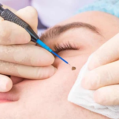 Skin Warts Removal Clinic in Abu Dhabi Al Ain Warts Removal