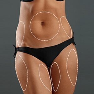 Blog 9 Smart Lipo in Abu Dhabi Al Ain Smart Lipo Cost