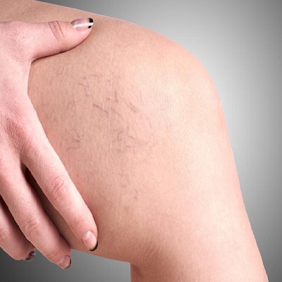 Spider Veins Treatment – Sclerotherapy