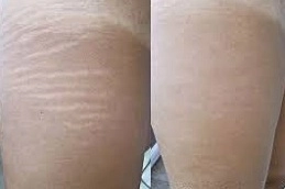 Stretch Marks Removal Treatment 8 Stretch Marks Removal Abu Dhabi