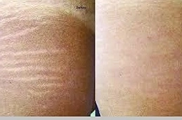 Stretch Marks removal in Abu Dhabi