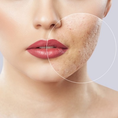 Subcision Treatment for Acne Scar 2 Subcision Treatment For Acne Scars in Abu Dhabi khalifa City Al Ain