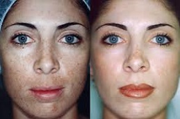 TCA Peel 8 TCA-Peel-in-Abu-Dhabi-Al-Ain