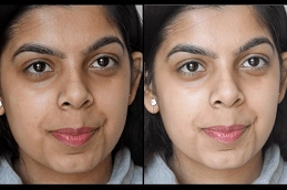 Tan-Removal-Treatments-in-Abu-Dhabi-Clinic