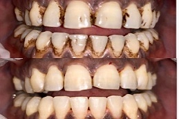 Teeth-Cleaning-in-Abu-Dhabi