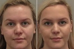 Teeth-Grinding-Treatment-in-Abu-Dhabi-Al-Ain