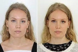 Teeth Grinding Treatment 5 Teeth-Grinding-Treatment