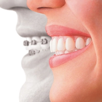 Teeth Straightening & Alignment 2 Teeth Straightening & Alignment in Abu Dhabi & Al Ain Cost & Price