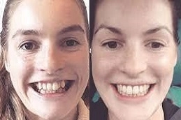 Teeth-Straightening-Alignment-in-Abu-Dhabi