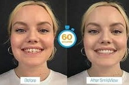 Teeth Straightening & Alignment 5 Teeth-Straightening-Alignment