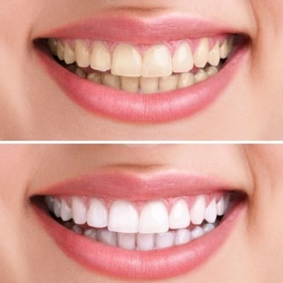 Teeth Whitening Abu Dhabi 2 Teeth Whitening in Abu Dhabi & Al Ain Zoom Whitening Cost