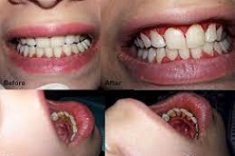 Teeth Polishing & Scaling Treatment 5 Teeth-polishing-Scaling-Treatment