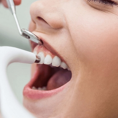 Teeth polishing & scaling Treatment In Abu Dhabi & Al Ain Treatment Cost
