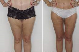 Thigh Lift Clinic in Abu Dhabi & Al Ain