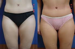 Thigh Lift Clinic