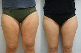 Thigh Lift 8 Thigh Lift in Abu Dhabi