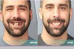 Tooth Removal 5 Tooth-Removal-in-Abu-Dhabi-Al-Ain