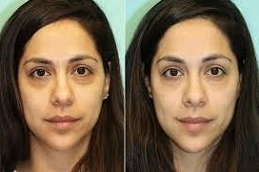 Under-Eye-Fillers-in-Abu-Dhabi