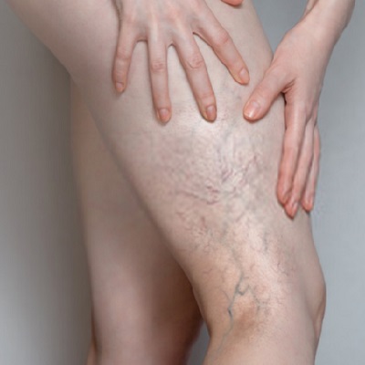 Varicose Veins Treatment in Abu Dhabi khalifa City Cost Price