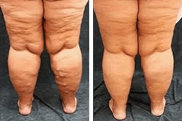Varicose Veins Treatment 5 Varicose Veins Treatment in Dubai