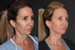 Vector-Facelift-in-Abu-Dhabi-Before-After.