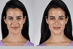 Volift-Fillers-Clinic-in-Abu-Dhabi