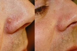 Wart Removal 8 Warts-Removal-Clinic-in-Abu-Dhabi