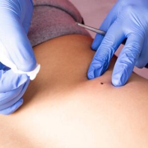 Blog 13 Procedure removing mole using a medical laser