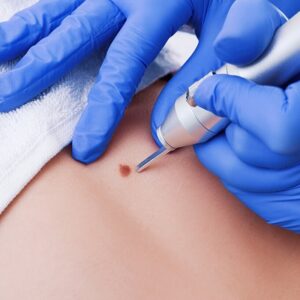 Blog 17 Warts Removal Price in Abu Dhabi Al Ain Cost and Benefits