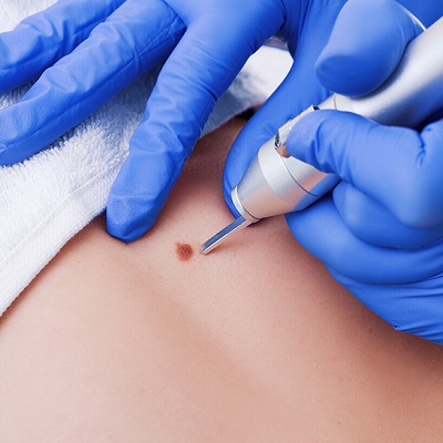 Warts Removal Price in Abu Dhabi Al Ain Cost and Benefits