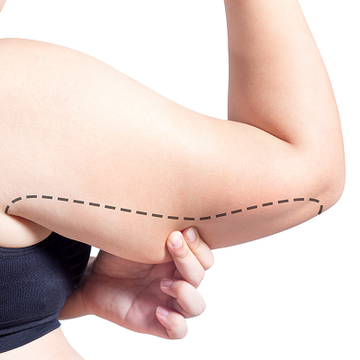 What Can I Expect After an Arm Lift? 4 What Can I Expect After an Arm Lift in Abu Dhabi Al Ain