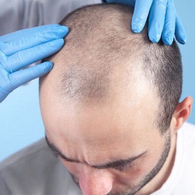 What is the Right Time For a Hair Transplant in Abu Dhabi