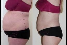 bODY jET lIPOSUCTION