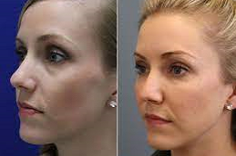 beletero fillers clinic in abu dhabi & al ain
