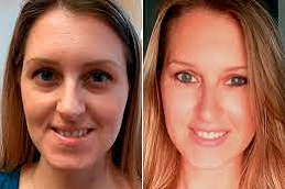 beletero fillers clinic in abu dhabi