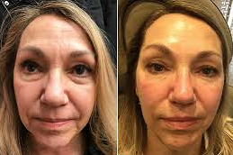 beletero fillers clinic