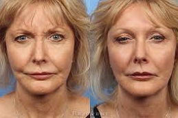 botox injections for Wrinkles in Abu Dhabi
