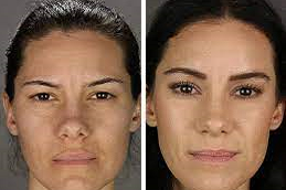 Brow Lift Surgery in Abu Dhabi Before and After