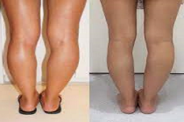 calf reduction in abu dhabi