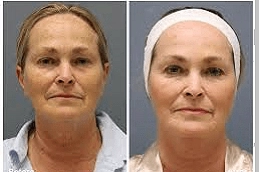 dermapen-treatment-Clinic-in-Abu-Dhabi