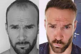 hair restoration clini in Abu Dhabi