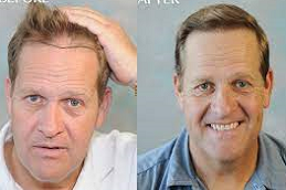 hair restoration clinic in UAE