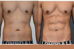 high defination liposculpture in abu ddhabi & al ain