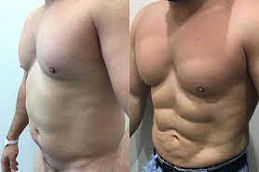 high defination liposculpture in abu dhabi