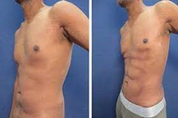 high defination liposculpture