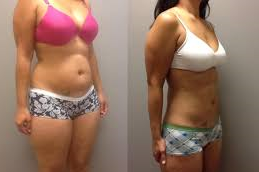 Liposuction in Abu Dhabi 5 liposuction surgery in Abu Dhabi