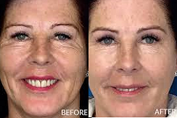 plexr plasmaClinic in Abu Dhabi