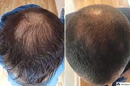 Stem Cell Hair Transplant 5 stem cell hair transplant