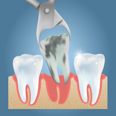 Cheapest Tooth Extraction in Abu Dhabi